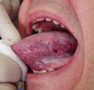 Black blister online in mouth