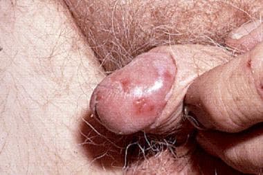 Erythroplasia of Queyrat, squamous cell carcinoma 