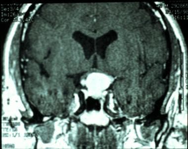 This contrast-enhanced coronal MRI was obtained in