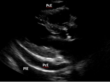 Ultrasound image of a pericardial effusion (PcE) i