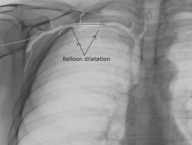 Balloon dilatation of right subclavian vein.