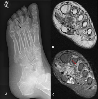 A 55-year-old female with a chronic history of lef