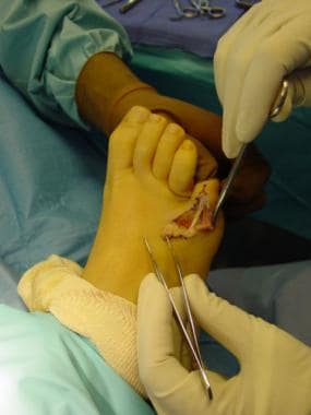 Fifth-toe deformities. Exposure showing severely c