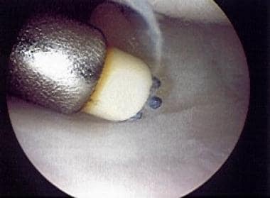 Palmer class 1A tear of triangular fibrocartilage 