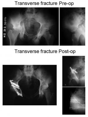 Transverse fracture. 