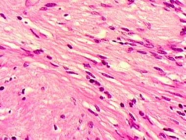 The cell of origin for a neurilemmoma is the Schwa