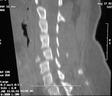 Sagittal CT scan of C5 burst fracture. 