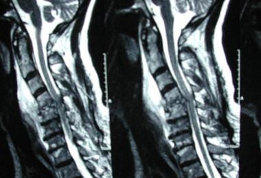 Spinal infections. T2-weighted MRI of Patient A. E