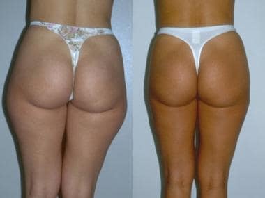 Long-Term Results of a Brazilian Buttocks Lift in Birmingham, AL