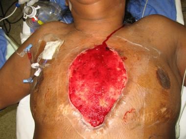 Chest wall infection after debridement of all nonv