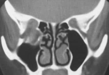 Coronal CT scan showing posterior extension of flo