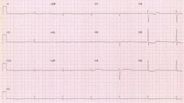 junctional bradycardia rhythm strip