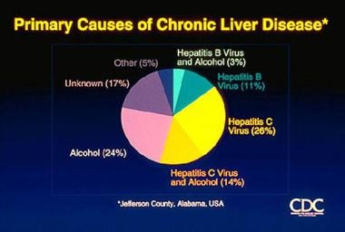 Hepatitis C. Causes of chronic liver disease. Cour