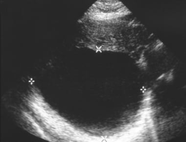 Ultrasonographic appearance of large simple hepati