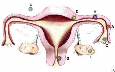 Sites and frequencies of ectopic pregnancy. By Don