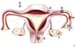 Ectopic Pregnancy