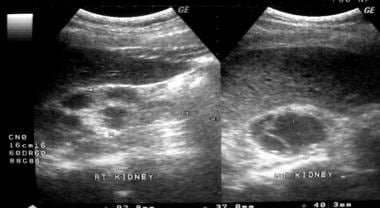 Retroperitoneal hemorrhage due to ruptured renal cyst in PCKD