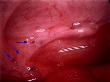 Typical appearance of minimal endometriosis on the