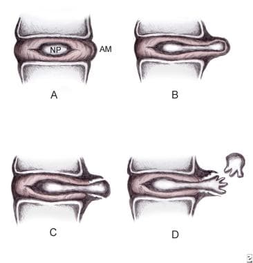 Disc herniation classification. A: Normal disc ana