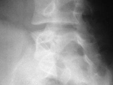 Lumbar oblique radiograph showing the "Scottie Dog