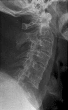 Radiograph shows vertebral fracture in a patient w