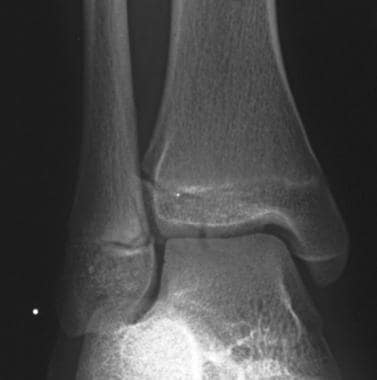 An 11-year-old girl with juvenile Tillaux fracture