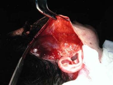 A cheek flap is developed in preparation for a dee