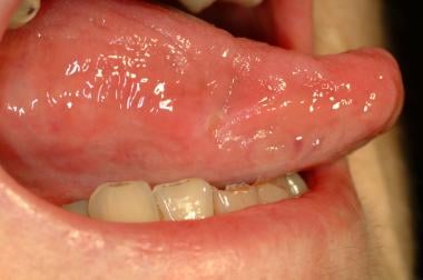 aphthous stomatitis tongue