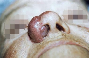 Merkel cell carcinoma affecting the right nasal al