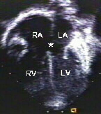 Two-dimensional, apical, four-chamber echocardiogr