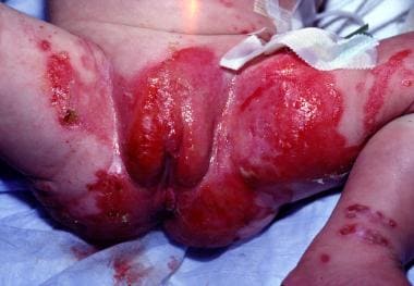 Skin lesions in the diaper area. 