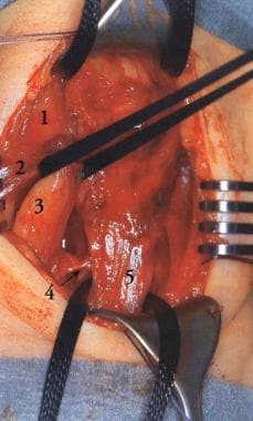 torticollis in adults