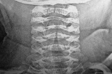 Steeple sign (trachea), Radiology Reference Article