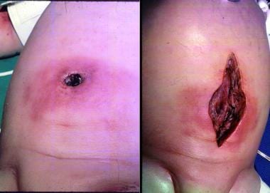 strep infection in belly button