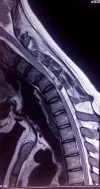 T2-weighted cervical spine MRI of the same patient