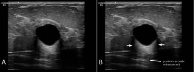 Breast cyst. A) A simple, fairly round breast cyst