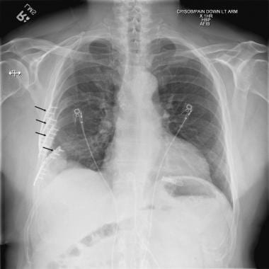 Se a gestão das fracturas múltiplas das costelas for com