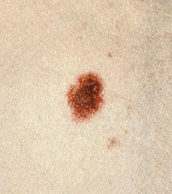 Atypical nevus. The central portion of this mole i