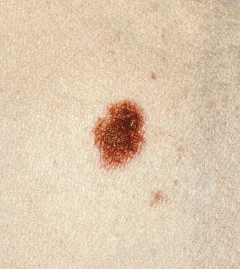 compound nevus with mild atypia