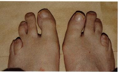 Abnormal second and third toes with a shortened fo