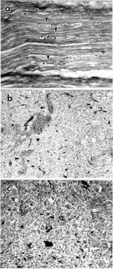 Dermatologic Manifestations of Paraneoplastic Syndromes: Overview