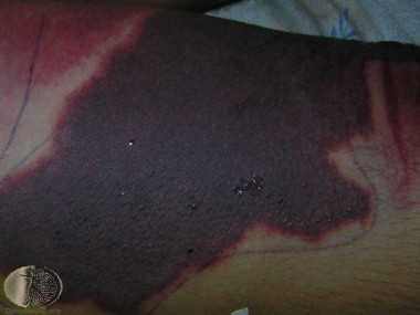 Lesion associated with purpura fulminans in an adu