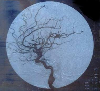 Early phase of the post-fistula coiling angiogram 