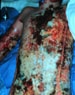 Thermal Burns
