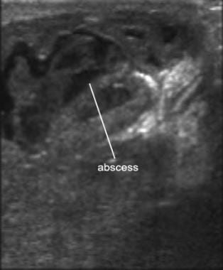 Ultrasound image of an abscess. Note the heterogen