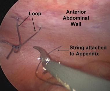 String attached to appendix is threaded through lo