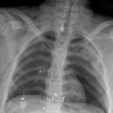 Frontal radiograph of the chest from a victim of a
