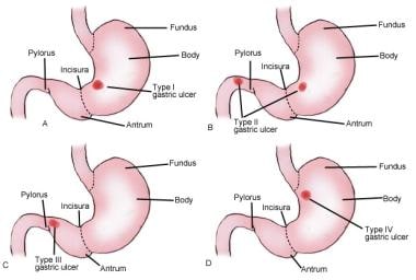 gastric ulcer types