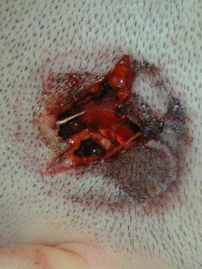 Hard contact gunshot wound with a stellate appeara