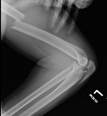 Lateral radiograph of concomitant ipsilateral mids